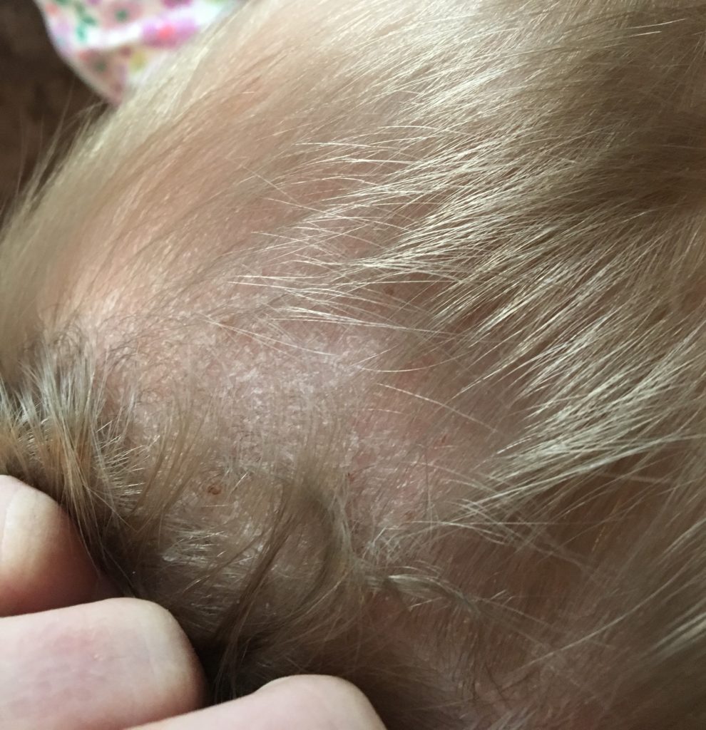 Close up of baby scalp with eczema.