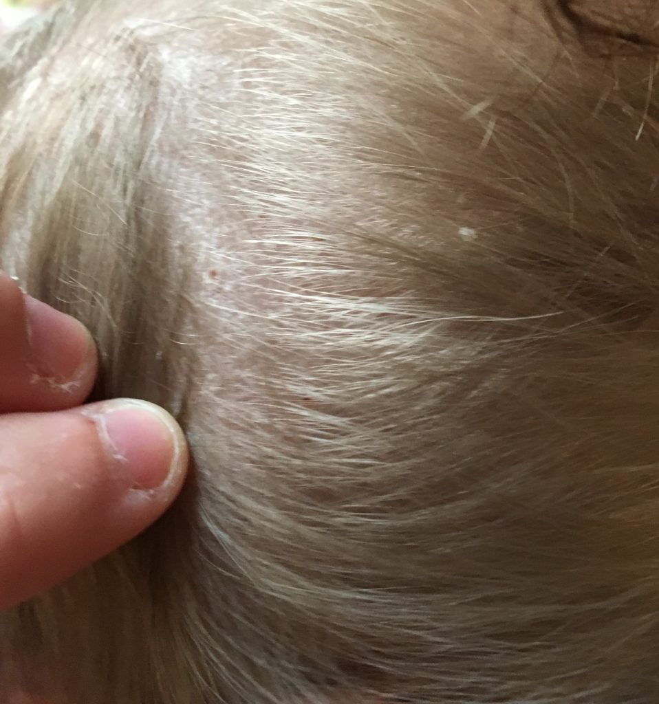 Baby scalp with flaky skin from eczema.