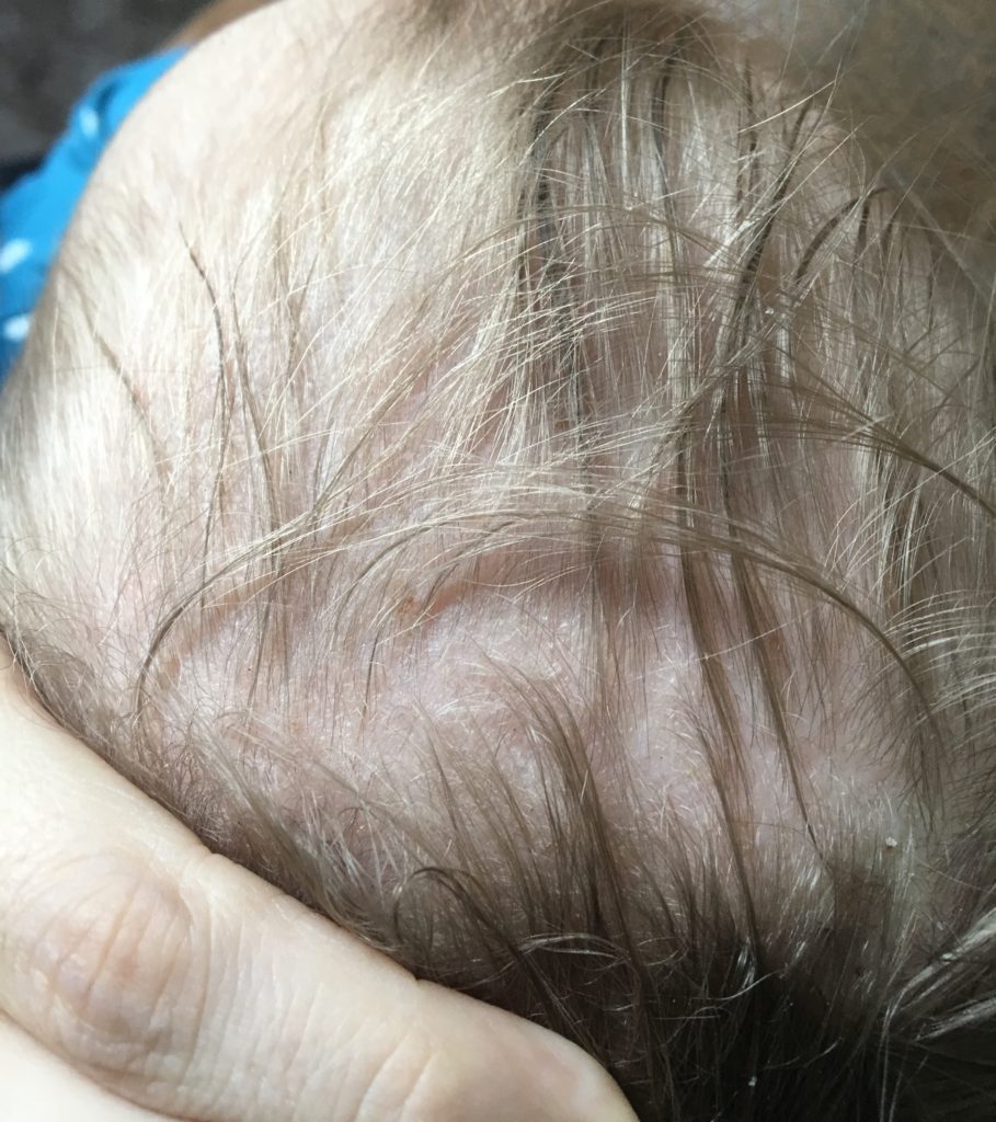 Close up of a baby\'s head after eczema treatment.