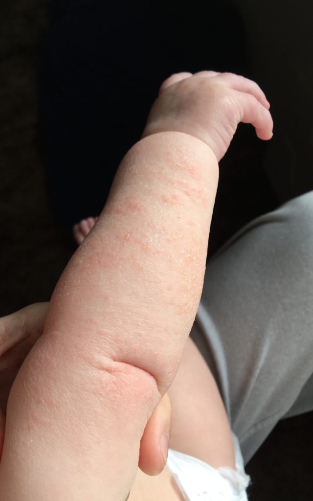 Baby lifts arm with rash from eczema.