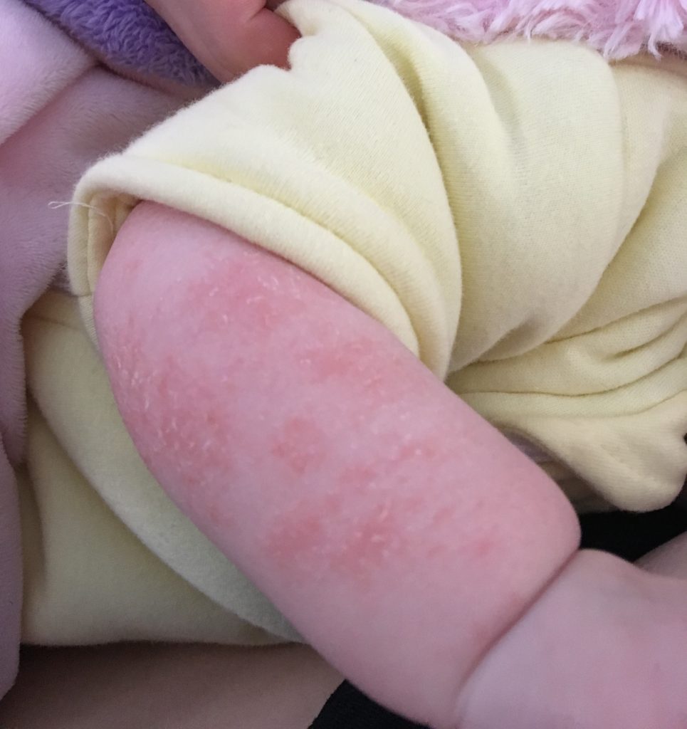 Baby arm with eczema rash.